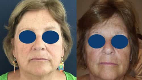 Before and after Facial Fat Grafting Colombia - Premium Care Plastic Surgery