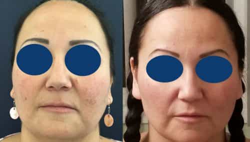 Before and after Facial Fat Grafting Colombia - Premium Care Plastic Surgery