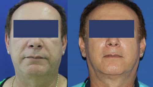 Facial Fat Grafting Colombia - Premium Care Plastic Surgery