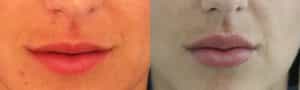 Lip Enhancement Colombia - Premium Care Plastic Surgery