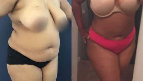 Liposuction Colombia - Premium Care Plastic Surgery