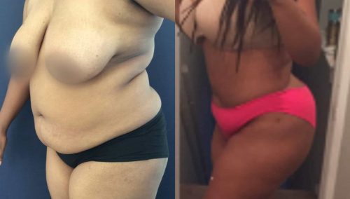 Liposuction Colombia - Premium Care Plastic Surgery