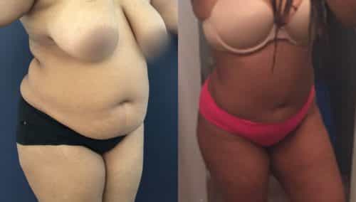 Liposuction Colombia - Premium Care Plastic Surgery