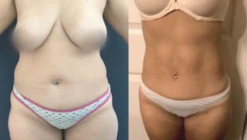 Liposuction Colombia - Premium Care Plastic Surgery