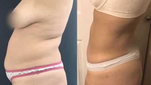 Liposuction Colombia - Premium Care Plastic Surgery