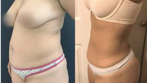 Liposuction Colombia - Premium Care Plastic Surgery
