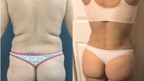Liposuction Colombia - Premium Care Plastic Surgery