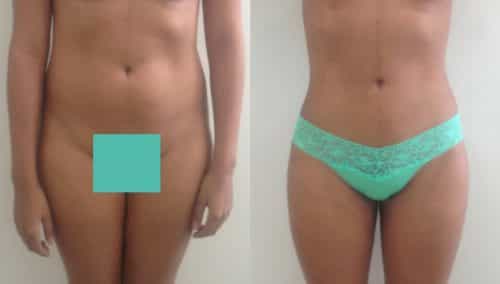 Before and After Liposuction Colombia - Premium Care Plastic Surgery