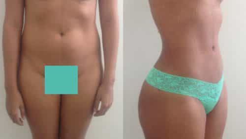 Before and After Liposuction Colombia - Premium Care Plastic Surgery