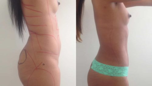 Before and After Liposuction Colombia - Premium Care Plastic Surgery