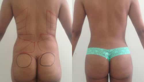 Before and After Liposuction Colombia - Premium Care Plastic Surgery