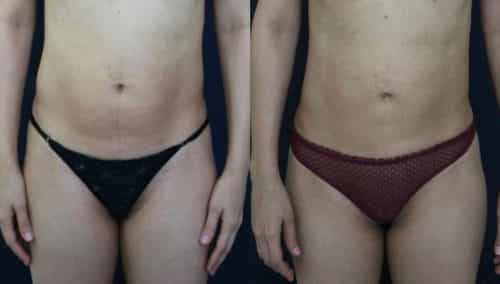 Before and After Liposuction Colombia - Premium Care Plastic Surgery