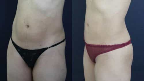 Before and After Liposuction Colombia - Premium Care Plastic Surgery
