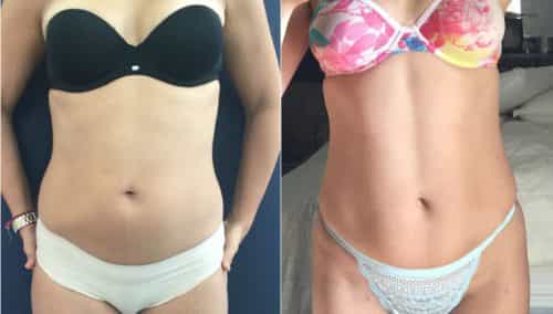 Liposuction Colombia - Premium Care Plastic Surgery