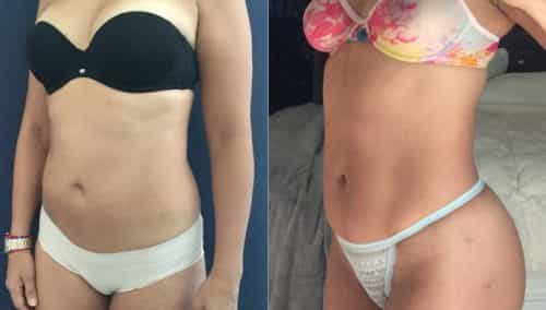 Liposuction Colombia - Premium Care Plastic Surgery