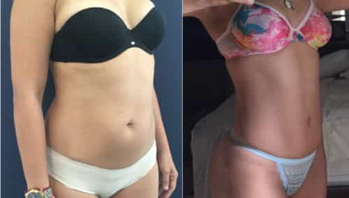 Liposuction Colombia - Premium Care Plastic Surgery