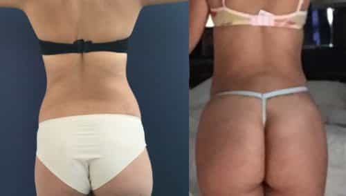 Liposuction Colombia - Premium Care Plastic Surgery