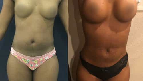 Liposuction Colombia - Premium Care Plastic Surgery