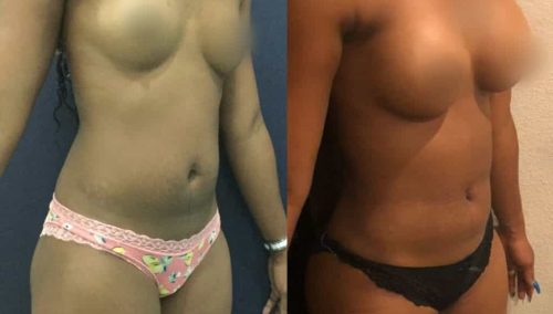 Liposuction Colombia - Premium Care Plastic Surgery