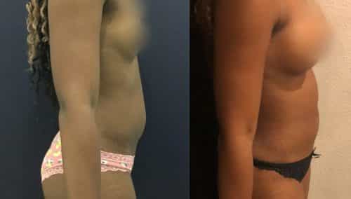 Liposuction Colombia - Premium Care Plastic Surgery