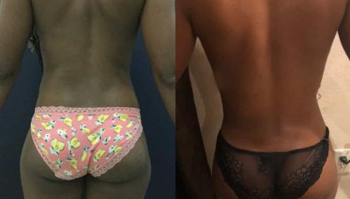 Liposuction Colombia - Premium Care Plastic Surgery