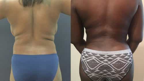 Liposuction Colombia - Premium Care Plastic Surgery