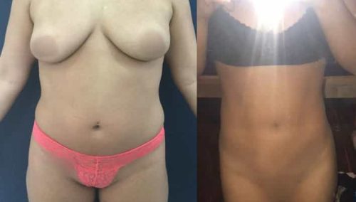 Liposuction Colombia - Premium Care Plastic Surgery
