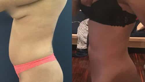 Liposuction Colombia - Premium Care Plastic Surgery