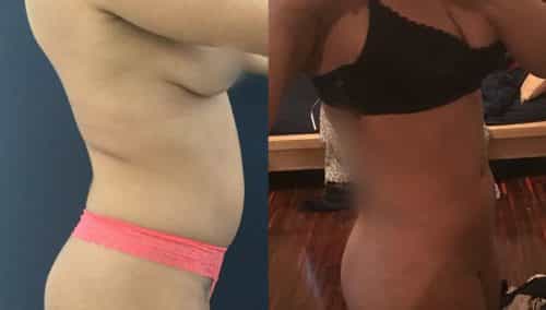 Liposuction Colombia - Premium Care Plastic Surgery