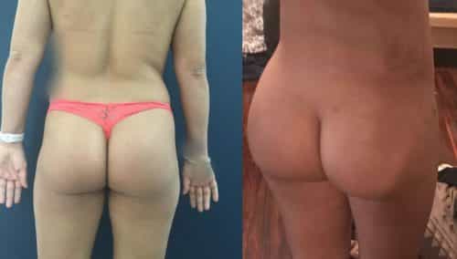 Liposuction Colombia - Premium Care Plastic Surgery