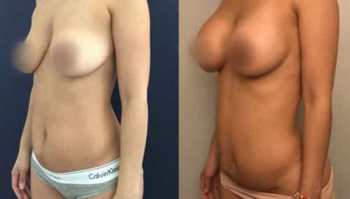 Liposuction Colombia - Premium Care Plastic Surgery