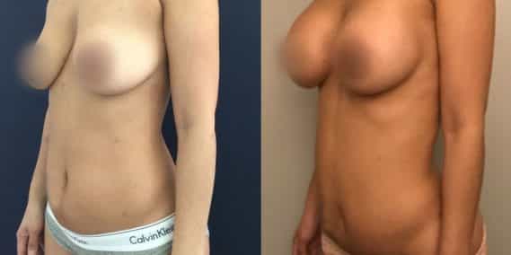 Liposuction Colombia - Premium Care Plastic Surgery