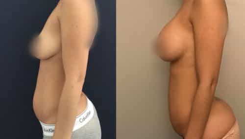 Liposuction Colombia - Premium Care Plastic Surgery