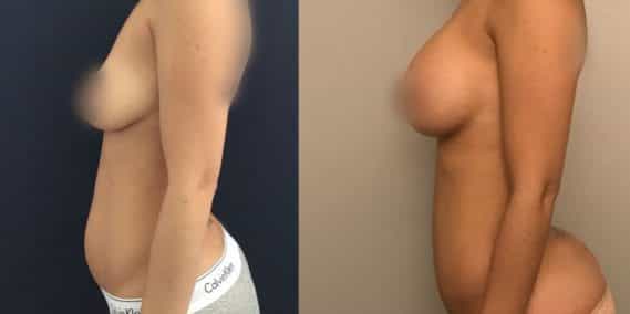 Liposuction Colombia - Premium Care Plastic Surgery