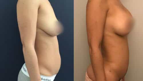Liposuction Colombia - Premium Care Plastic Surgery