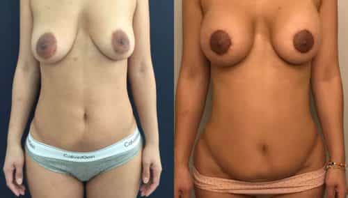 Liposuction Colombia - Premium Care Plastic Surgery