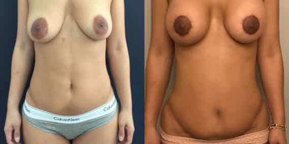 Liposuction Colombia - Premium Care Plastic Surgery