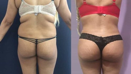 Liposuction Colombia - Premium Care Plastic Surgery