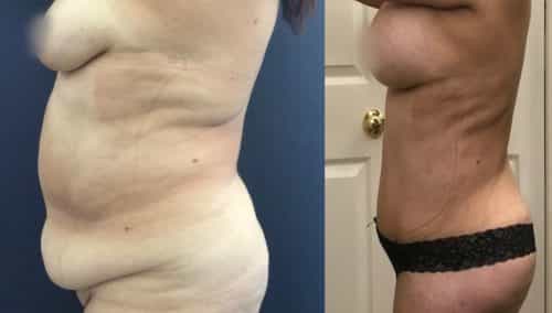 Liposuction Colombia - Premium Care Plastic Surgery
