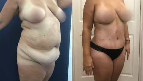 Liposuction Colombia - Premium Care Plastic Surgery