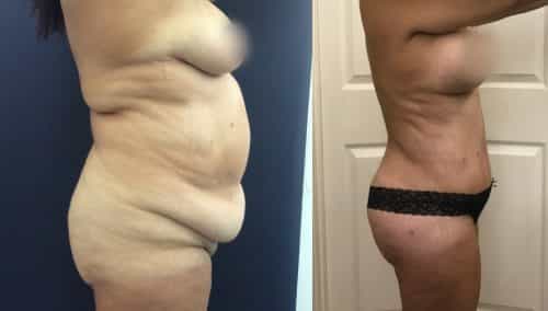 Liposuction Colombia - Premium Care Plastic Surgery