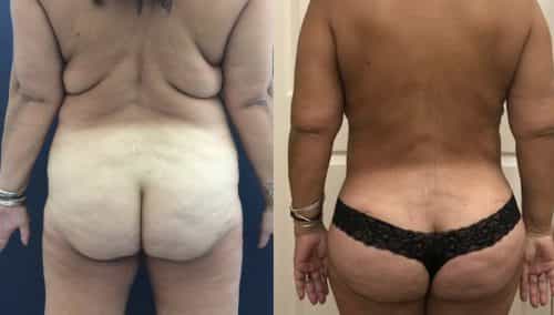 Liposuction Colombia - Premium Care Plastic Surgery