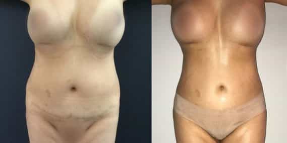 Liposuction Colombia - Premium Care Plastic Surgery