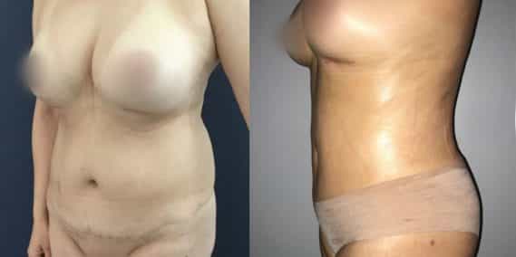 Liposuction Colombia - Premium Care Plastic Surgery