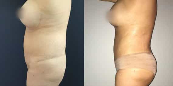 Liposuction Colombia - Premium Care Plastic Surgery