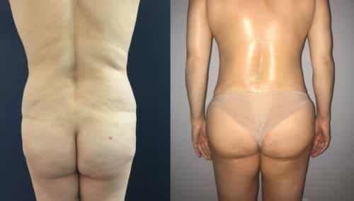 Liposuction Colombia - Premium Care Plastic Surgery