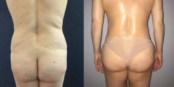 Liposuction Colombia - Premium Care Plastic Surgery