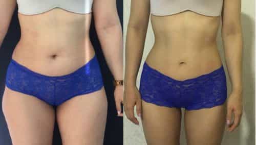 Liposuction Colombia - Premium Care Plastic Surgery