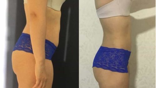 Liposuction Colombia - Premium Care Plastic Surgery