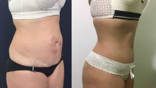 Liposuction Colombia - Premium Care Plastic Surgery